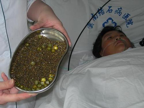 什么因素容易引发胆结石胆囊结石是很平常的结石病之一