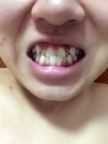 牙齿不齐能当兵吗?如图