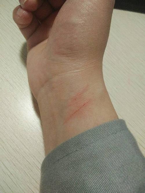 被小猫抓破了皮,流了一点点血,需要打狂犬疫苗吗