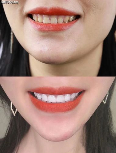 美牙贴面适合那些人做比较好,那些人是不能做?_牙齿