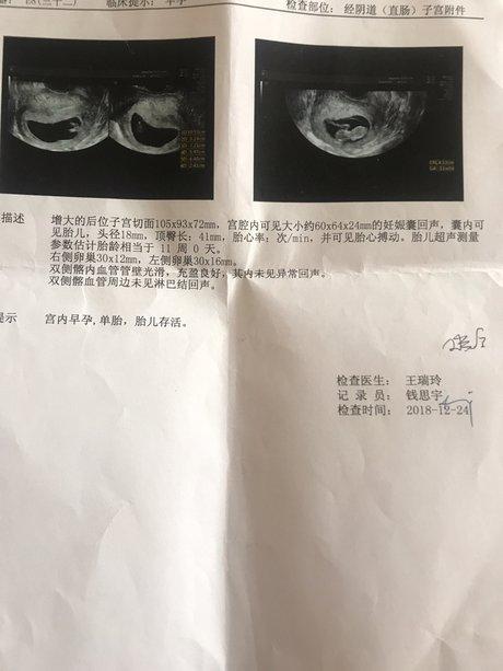 根据 b超显示, 怀孕11周胎儿发育大小是否正常
