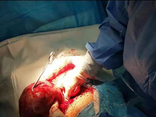 快速病理检查显示子宫平滑肌瘤合并红色变性,术中一并切除子宫体后壁6