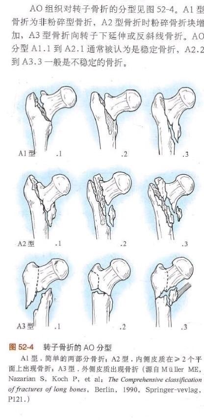 股骨粗隆间骨折的ao分型