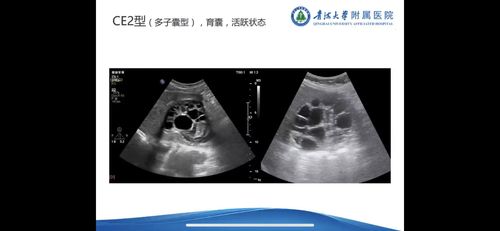 肝包虫病的超声分型与鉴别诊断