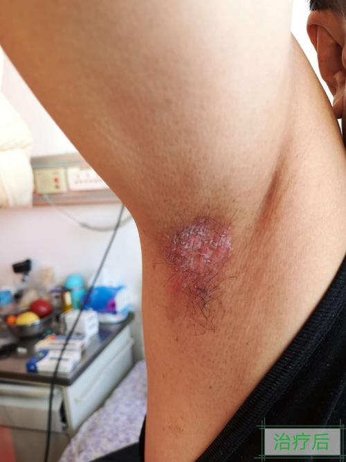 家族性良性慢性天疱疮的诊断与治疗