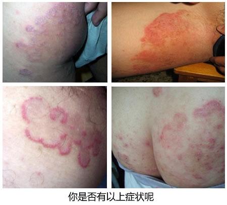 体股癣股癣(tinea cruris)指发生于腹股沟,会阴和肛门周围的皮肤癣菌