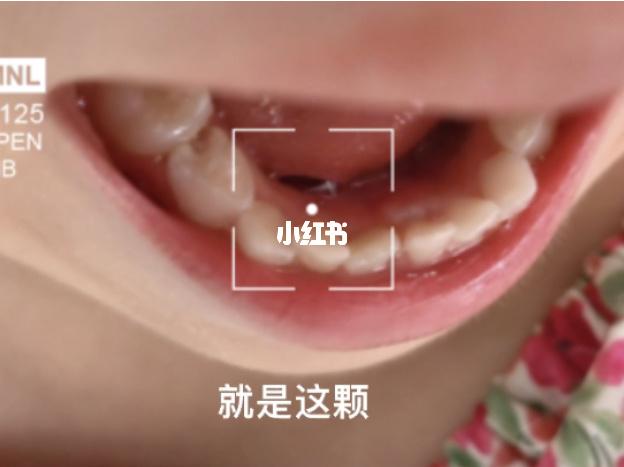 乳牙07没有脱落,恒牙已经长出来_牙齿矫正_乳牙滞留