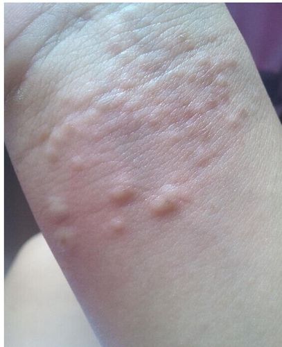 痒得很.一直想挠.今天看到一个癌症女孩也有这种.有人能解答吗