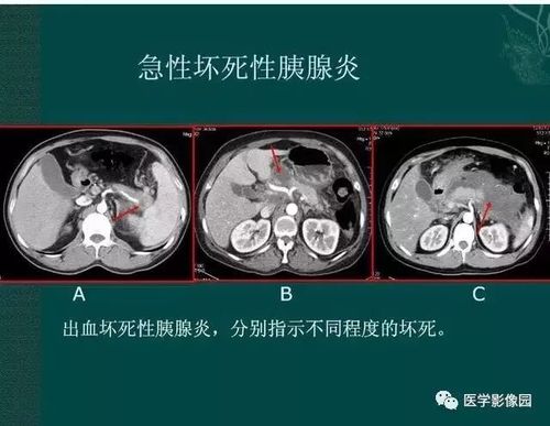 急性胰腺炎ct评价