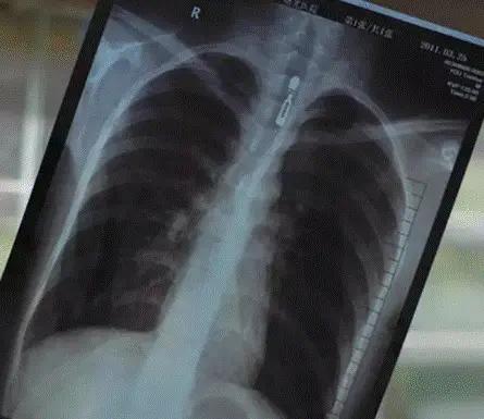 做"胸透"医生通过机器能看见什么?看完就知道