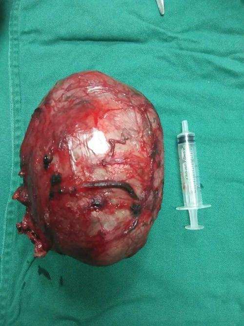 我院泌尿外科完成首例巨大睾丸肿瘤完整切除术