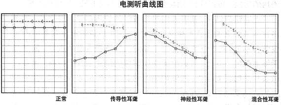 老年性耳聋的听力图曲线及相关因素影响