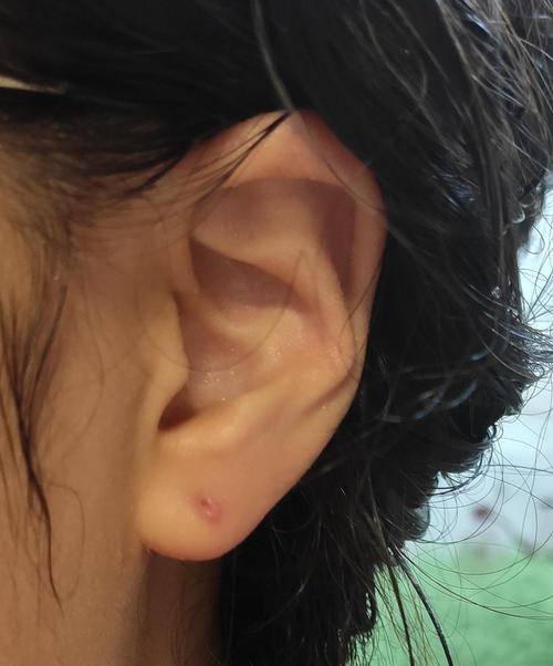 求助,打耳洞出现的硬块肿包怎么办呀.(更新)是增生,有