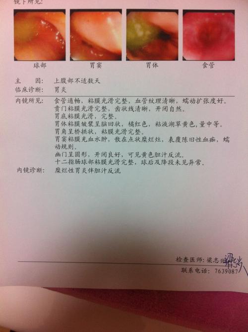 问:胃窦糜烂,胃窦黏膜充血水肿,每当胃快排空的时候胃窦部位就疼,也就