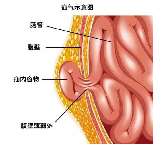 肚子上鼓了个小包?别忽视,否则可能会有严重后果