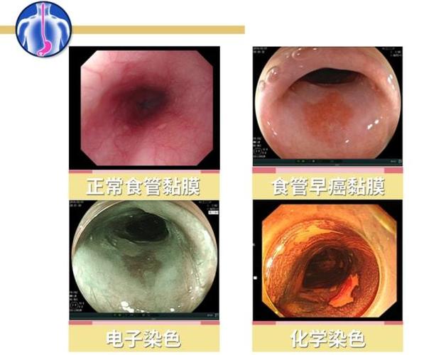 做胃镜检查到底有多难受专家说再难受这5类人也必须做
