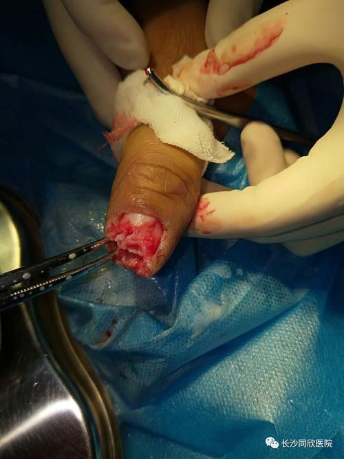 手术成功后,伤者可保留患指基本长度及功能,目前,该患者皮瓣血运良好