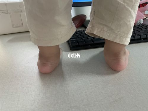 这个是足内翻嘛?_走路姿势_萌娃_宝宝日常