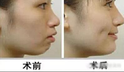 炫腹秀锁骨晒胸out!酒窝吸笔盖才高能_自体脂肪移植