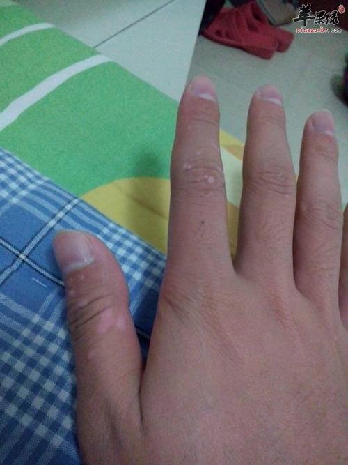 疣的不同种类症状和治疗方法