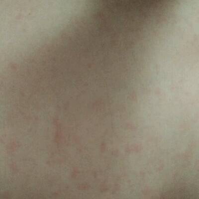 六个月宝宝身上全是这样红点点,不痛不痒也不发烧精神