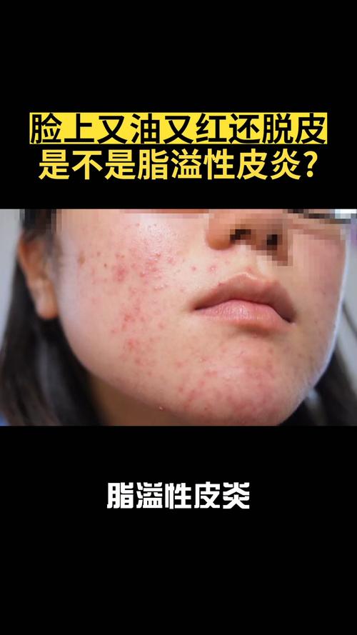 脸上又红又油还脱皮,是脂溢性皮炎吗?