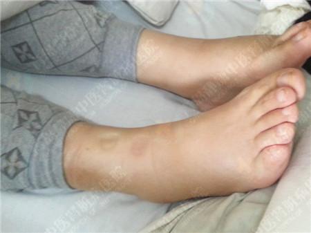 肾病综合征老人水肿久治不愈 来静康一个月消肿32斤