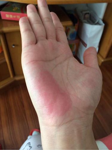 手掌变红 正常情况下我们的手掌并不会变红,但是如果肠胃不适或是