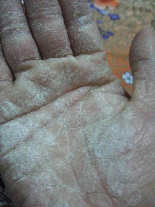 我双手掌,好痒,皮硬,开裂
