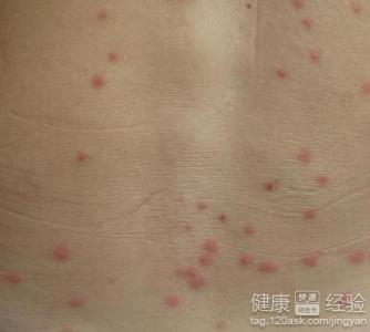 丘疹性荨正文  1通过丘疹性荨麻疹的症状图片,我们能够发现它的产生