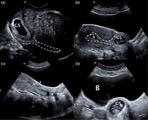 孕早期疤痕妊娠的一线治疗方案:人工流产术