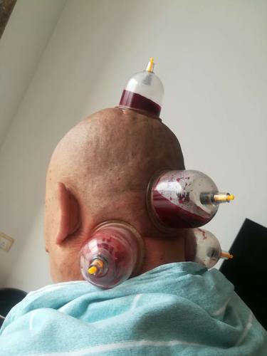 刺血拔罐取栓的好处和坏处|必看