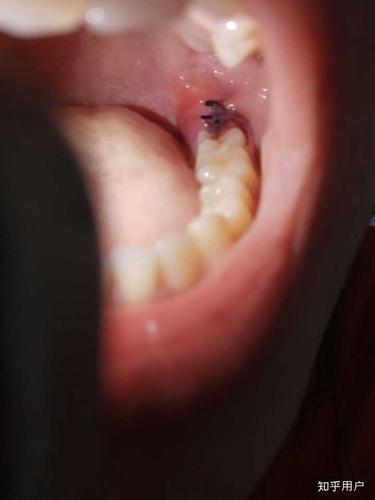 拔完智齿第一天这上面长得是白色假膜吗?