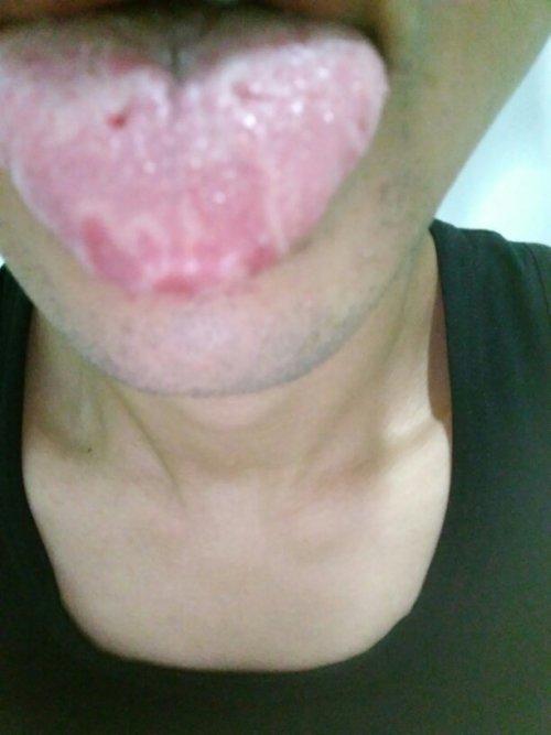 舌头老是发麻怎么回事