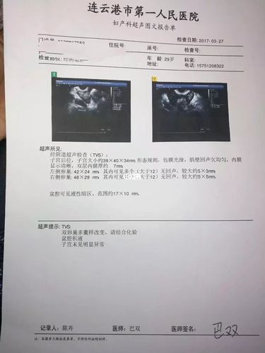 多囊卵巢综合症患者_临沂攻略_备孕_多囊备孕_医疗健康_医疗健康其他