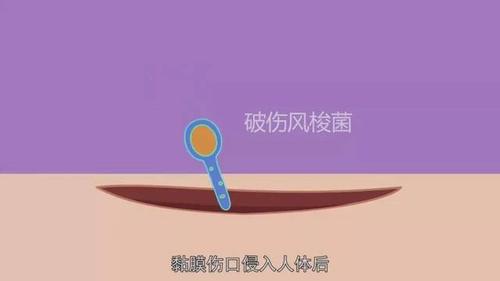 破伤风这个词很多人都听过,但只知道跟伤口有关.破伤风究竟是什么鬼?