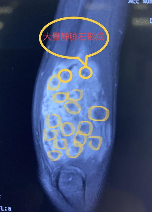 儿童血管畸形静脉畸形医学科普