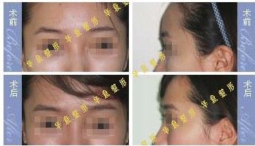 隆眉弓前后对比图