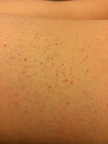 问:身上出现了红色斑点,皮下的出血小点点,不痛不痒,多处四肢和身上