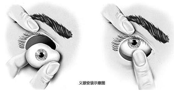 什么是义眼台手术?