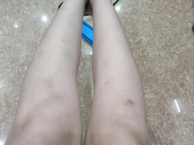 今天看到dy有人说他朋友也是这种情况,一查是白血病,好可怕