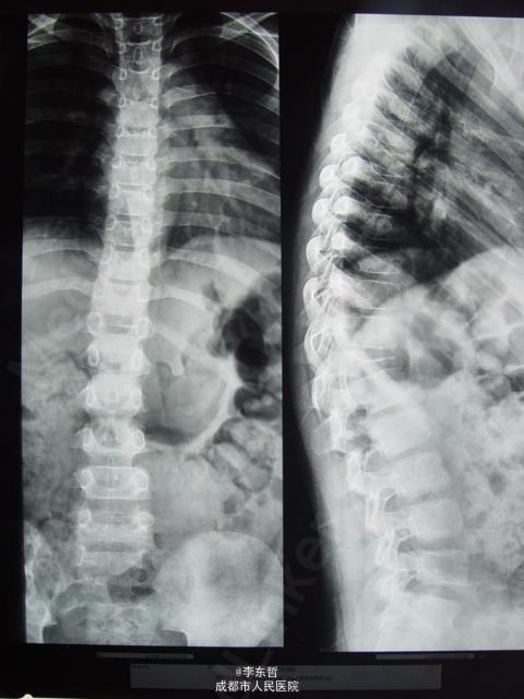 胸椎嗜酸性肉芽肿