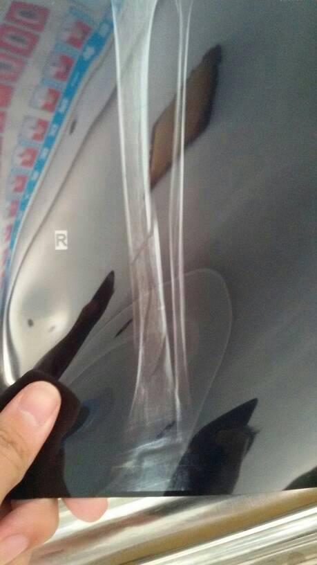 我是六月十八号摔着的,胫骨远端螺旋形骨折,下图是九月三号拍的片子