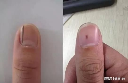 指甲长这样竟是癌症的信号出现这些异样可能已是大病