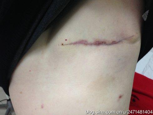 女性乳腺癌手术后防止复发