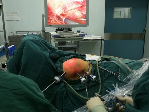 乳腺囊肿的腔镜微创手术