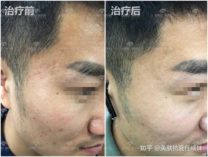 激光祛痘印是什么