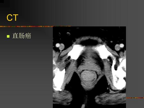 【ppt】结直肠癌的ct/mri影像进展