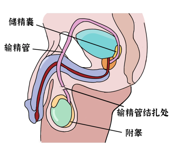 慢性病 神经官能症,身体虚弱的女性 并不能做结扎手术 男性结扎的原理