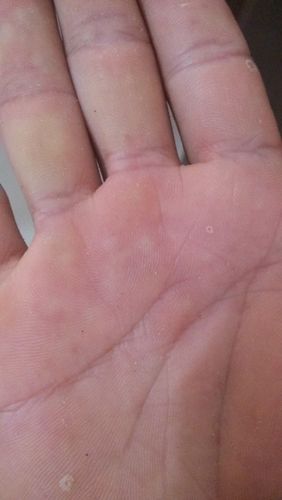 出现这种水泡 手掌出冷汗的时候这种水泡特多 如图白色的 点